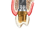 implantációs fogpótlás