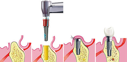 fogbeültetés, implantáció